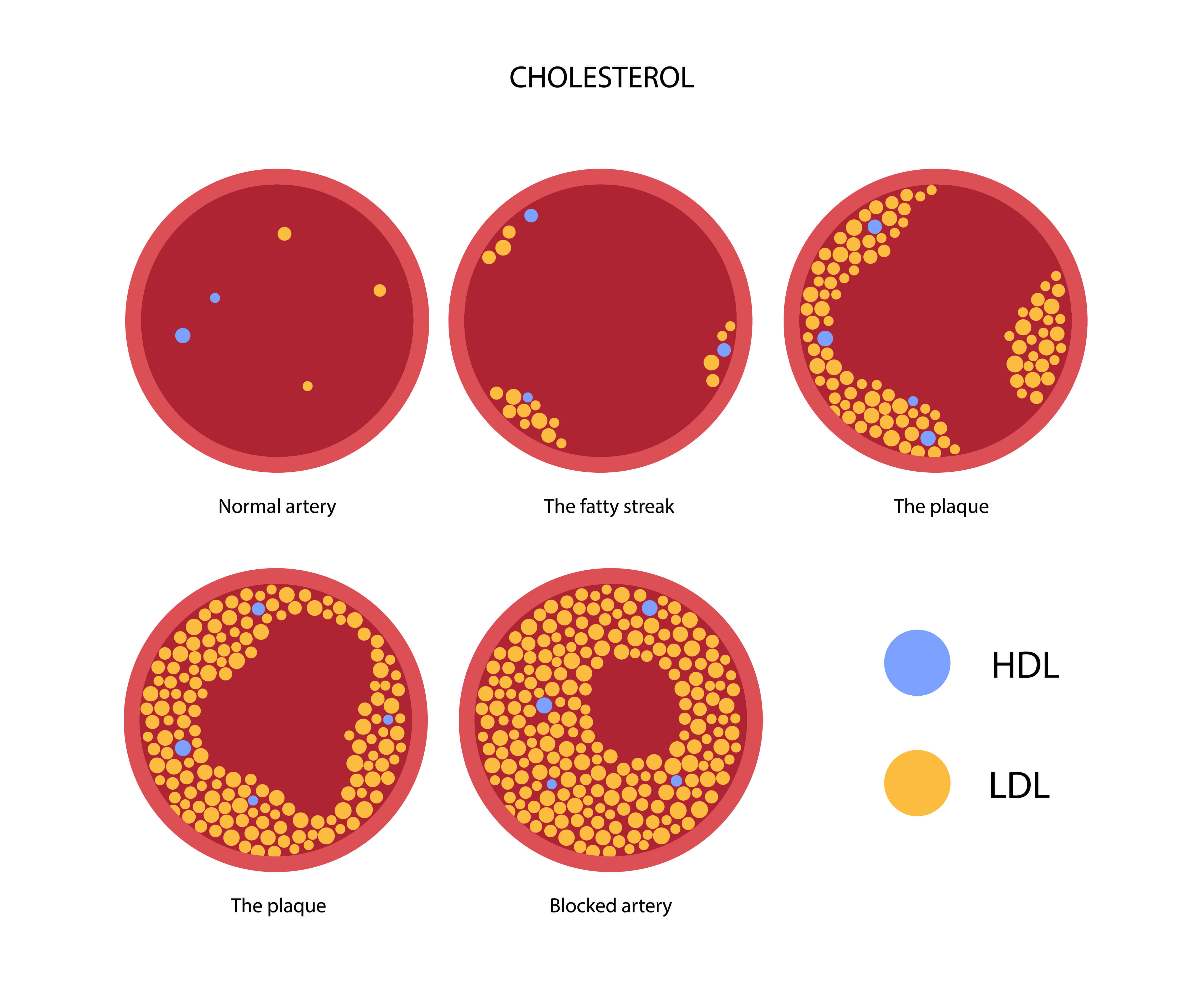 콜레스테롤(HDL, LDL)