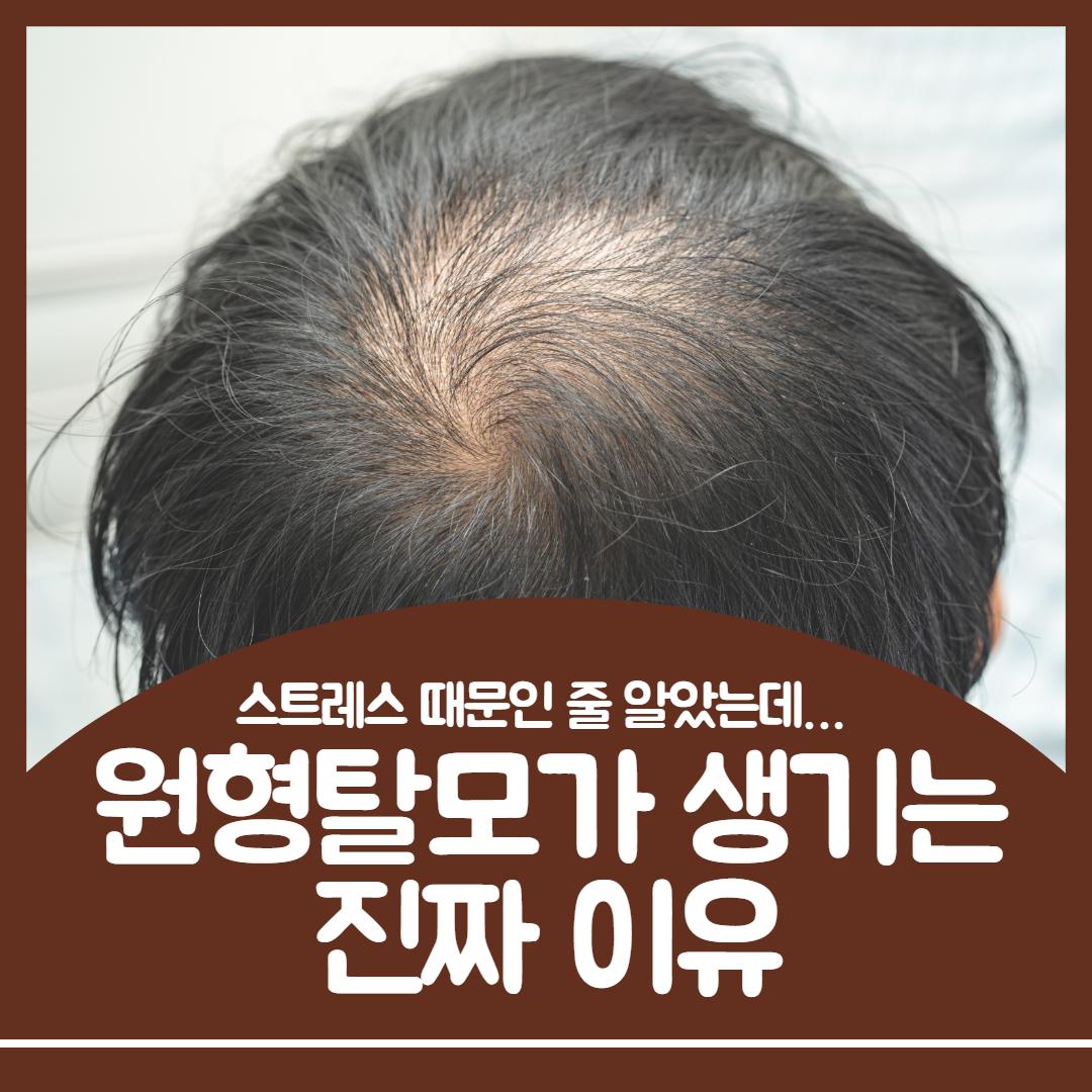 원형탈모 원인1.jpg