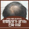 스트레스 때문인 줄 알았는데… 원형탈모가 생기는 진짜 이유